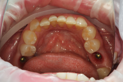 Мягкие ткани в области 3.6 и 4.6 зубов после снятия формирователей десны